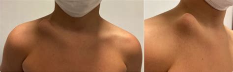 Congenital Pseudoarthrosis Of The Clavicle