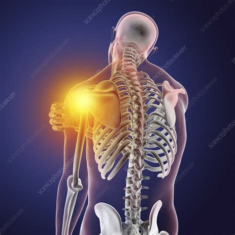 Painful Shoulder Illustration Stock Image F0356357 Science