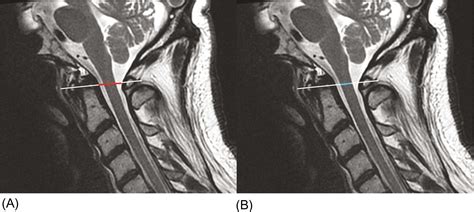 Upper Cervical Spine MRI Radiology Key