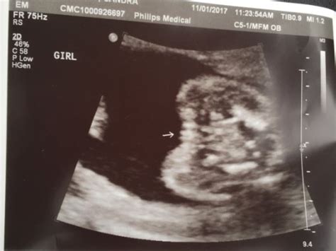 There was some confusion because my last period was about december 26 of 2013, but the first week of xxxxxxx i had a very short period and only bled one day. Dating ultrasound before 10 weeks - XXX photo