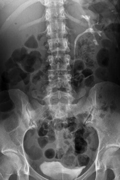 Normal Variant And Congenital Anomalies Radiology Key