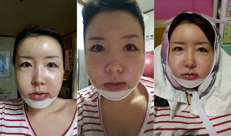 Plastic Surgery Experience Plastic Surgery Review In South Korea