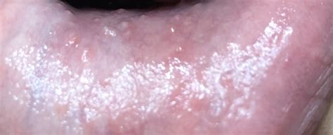 Is mouth herpes contagious, symptoms of mouth herpes, signs, early signs, pictures,photos, treatment, remedies, cures. Bumps inside bottom lip... ANYONE SEE OR KNOW ANYTHING ABOUT THIS?!?! | Sexual Health | Forums ...