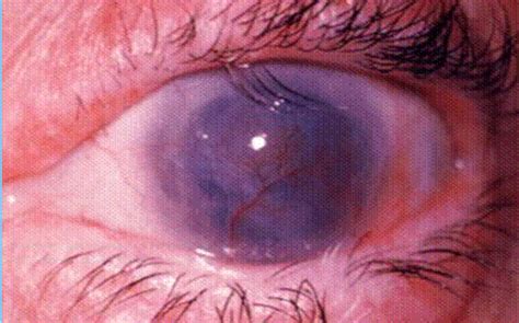 Trachoma Causes Symptoms Treatment Pictures Diagnosis Definition