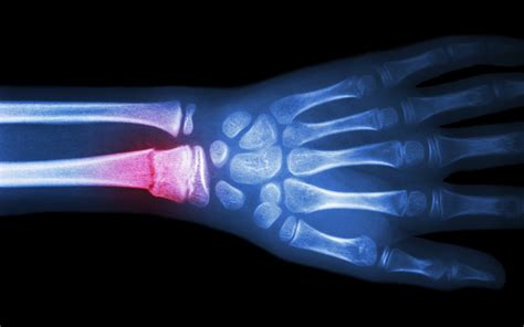 A Promising New Strategy To Help Broken Bones Heal Faster Penn Today