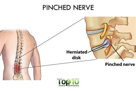 Home Remedies For A Pinched Nerve Top 10 Home Remedies