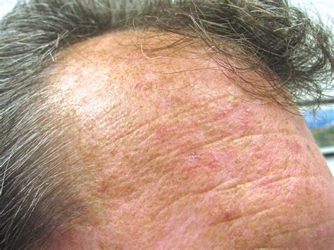 Making Heads And Tails Of Actinic Keratoses