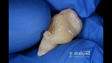 Extracted Wisdom Tooth With Curved Roots Youtube