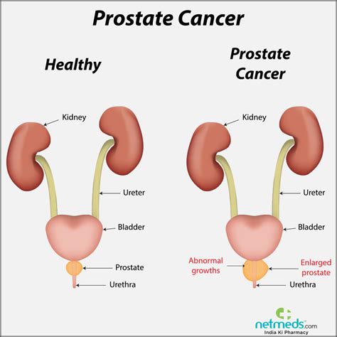 Prostate Cancer Causes Symptoms And Treatment Netmeds