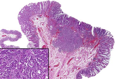 Serrated Colorectal Polyps And Polyposis Diagnostic Histopathology