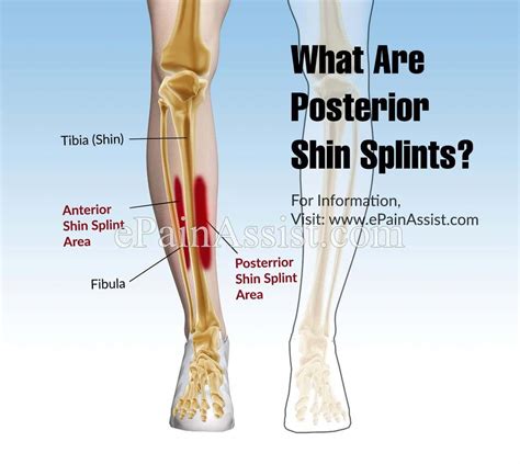 Pin On Shin Splint Recovery Exercises
