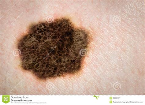 Melanoma Skin Cancer Mole Skin Disease Royalty Free Stock