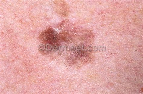 Malignant Melanoma Photo Skin Disease Pictures