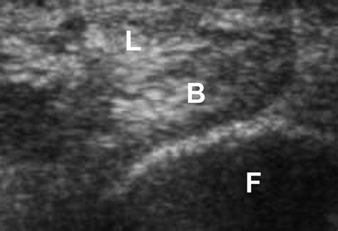 Dynamic Sonographic Evaluation Of Peroneal Tendon Subluxation Ajr