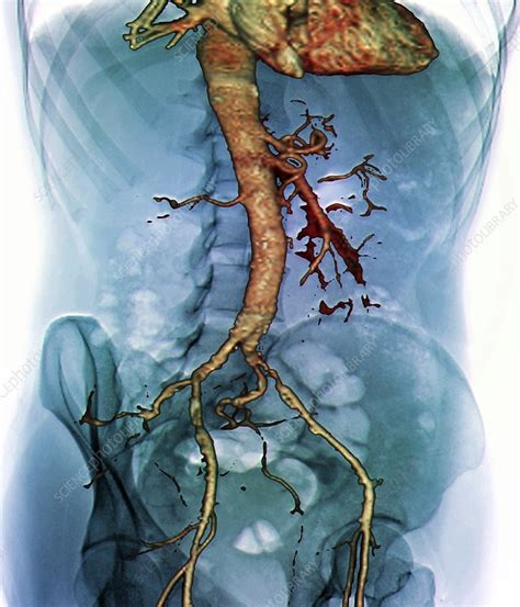 Abdominal Aorta 3d Ct Scan Stock Image C0166542 Science Photo