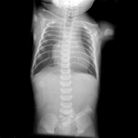 Esophageal Atresia Radiology Reference Article Radiopaedia Org The