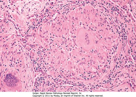 Sarcoid Granuloma Pictures Photos