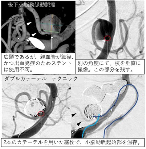 脳血管内治療の紹介｜脳卒中センター｜圏央所沢病院｜