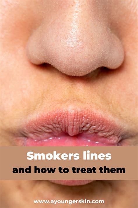 Best Treatments For Smokers Lines Lip Lines Around Your Mouth