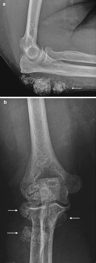 Soft Tissue Calcifications Radiology Key