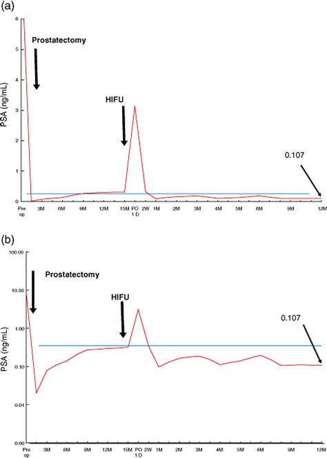 Transrectal High‐intensity Focused Ultrasound For Treatment For