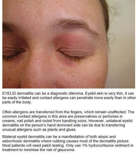 Consultations In Dermatology Eyelid Dermatitis