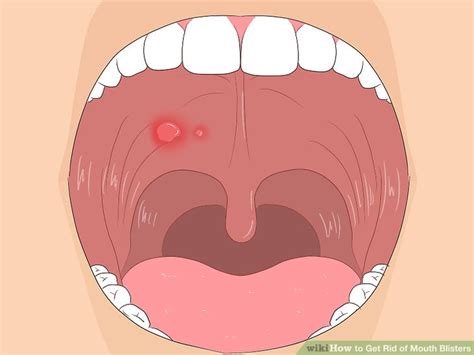 3 Ways To Get Rid Of Mouth Blisters Wiki How To English