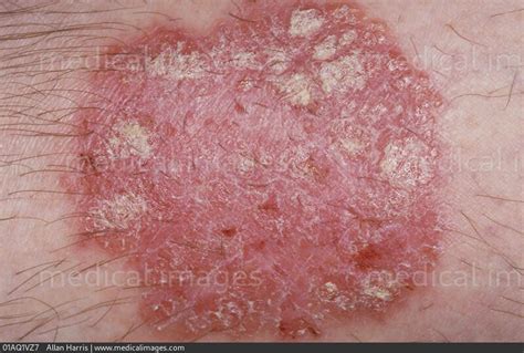 Stock Image Dermatology Moderate Psoriasis Close Up Of A Round Red