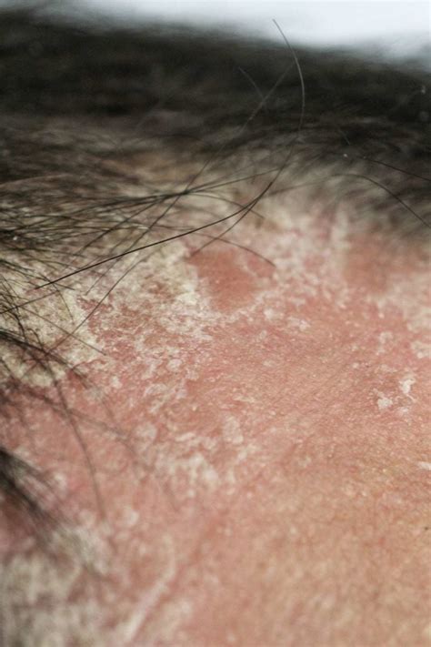 Skin Condition Psoriasis