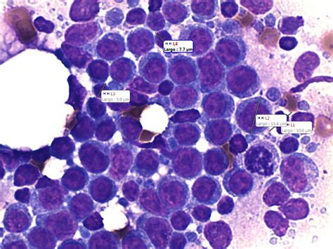 Giant Cell Lymphoma B Cd21 Cytology Taken And Interpreted By Renato