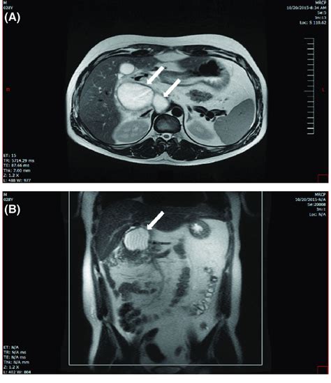 Mrcp Cuts Showing The Pancreatic Mass White Arrows As It Appeared