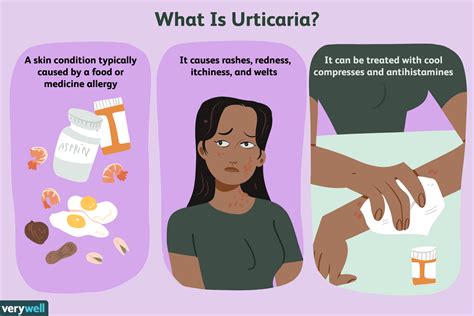 Urticaria Hives Overview And More