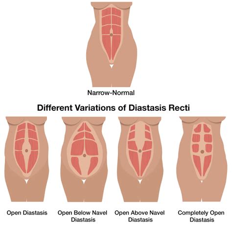 How To Know If You Have Diastasis Recti Beyond Fit Mom
