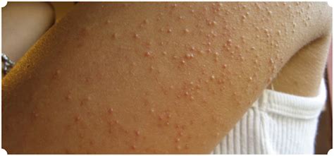 Keratosis Pilaris Bumpy Skin By David Robles Md Phd