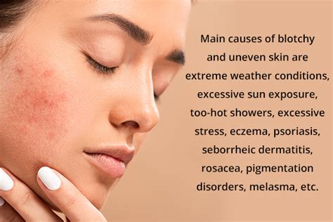 What Causes Blotchy Skin And How To Treat It Emedihealth