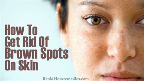 Top 7 Remedies To Get Rid Of Brown Spots On Skin