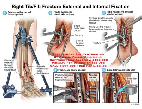 Tibfib Fracture External And Internal Fixation