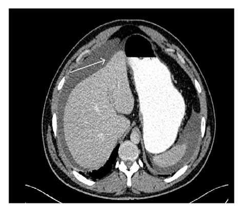 A Abdominal Ct With Oral And Intravenous Contrast Demonstrated