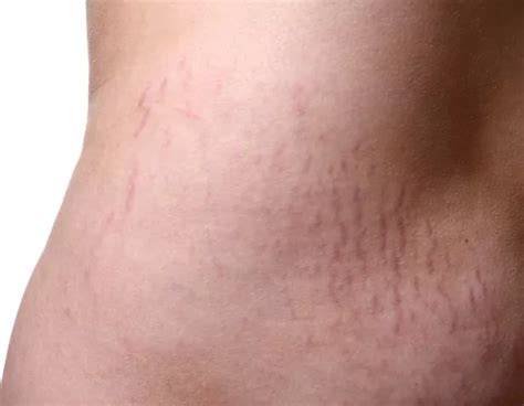 How To Get Rid Of Stretch Marks The Causes Best Products And How To Hide Or Reduce Mirror