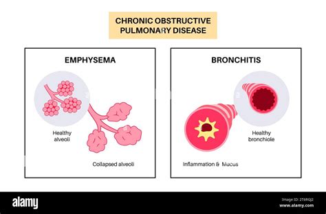 Chronic Obstructive Pulmonary Disease Illustration Stock Photo Alamy