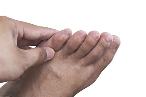 Foot Blisters Causes Treatment And Prevention Howard County Foot