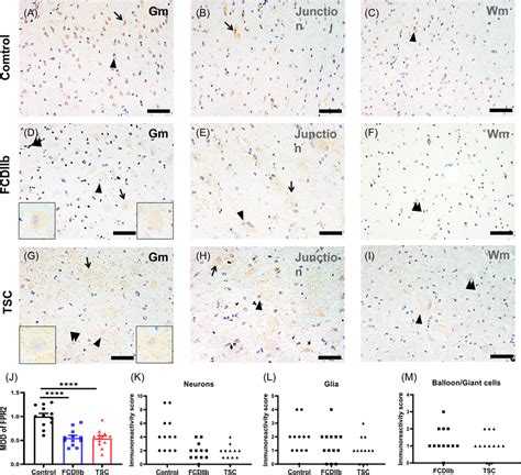 Distribution Of Fpr2 Ir In Fcdiib And Tsc Patients And Controls A C Download Scientific