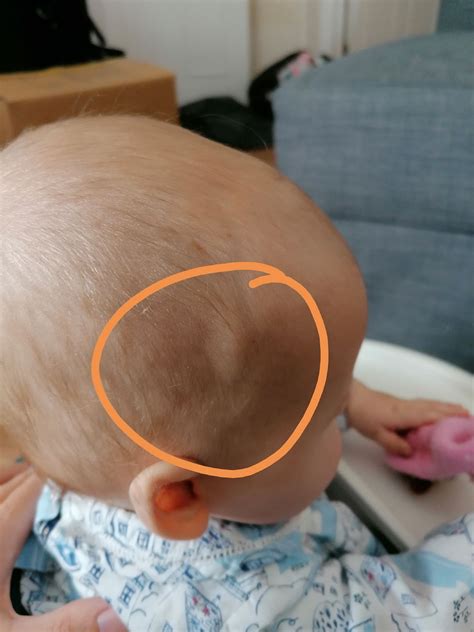 Hard Lump On Side Of Baby Head 5 Months Babycentre
