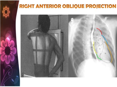 Ppt Chest Radiology Powerpoint Presentation Free Download Id2254706