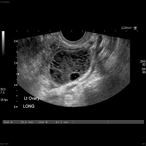 Exploring Sonograms For Ovarian Cysts Understanding The Role Of OB GYN