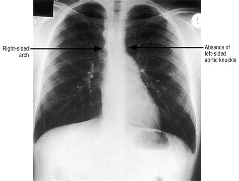 Right Sided Aortic Arch In Children With Persistent Respiratory