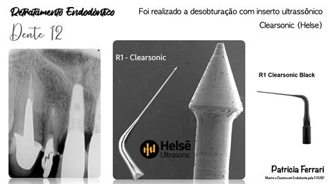 Retratamento Endod Ntico No Dente Patricia Ferrari Endodontia