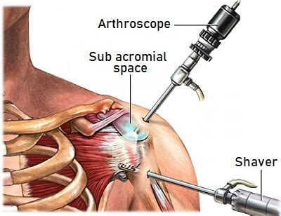 Subacromial Decompression Surgery For Shoulder Impingement
