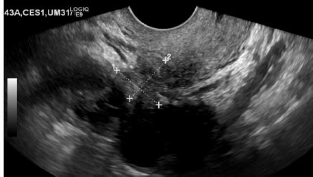 Extrapelvic endometriosis is a rare entity that presents serious challenges to researchers and clinicians. - Mulher de 43 anos com antecedentes de histerotomia. Na ...