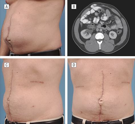 Abdominal Wall Reconstruction Lessons Learned From Components